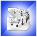basal implant price in India
